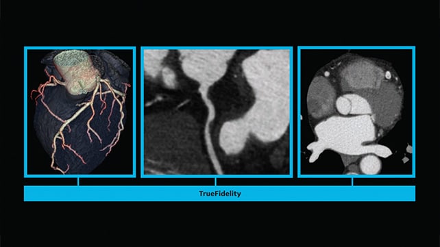 GE HealthCare Revolution Apex Elite CT for advanced diagnostic imaging