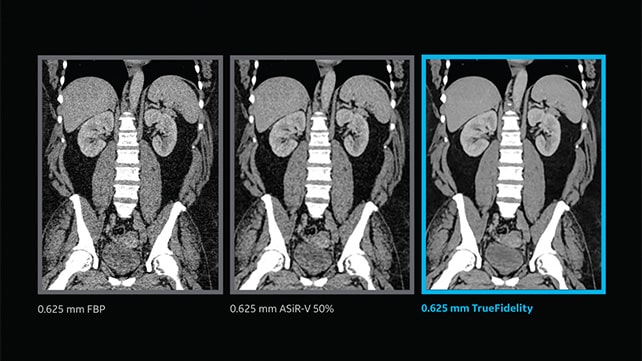 GE HealthCare Revolution Apex Elite CT for advanced diagnostic imaging