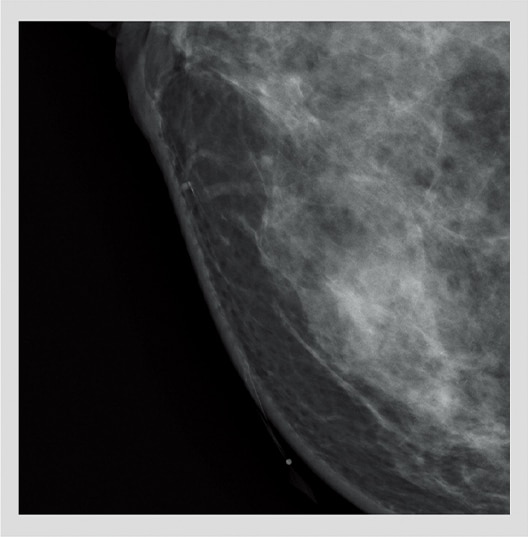 Mammografia digitale Amulet Sophinity di FUJIFILM per diagnostica senologica avanzata
