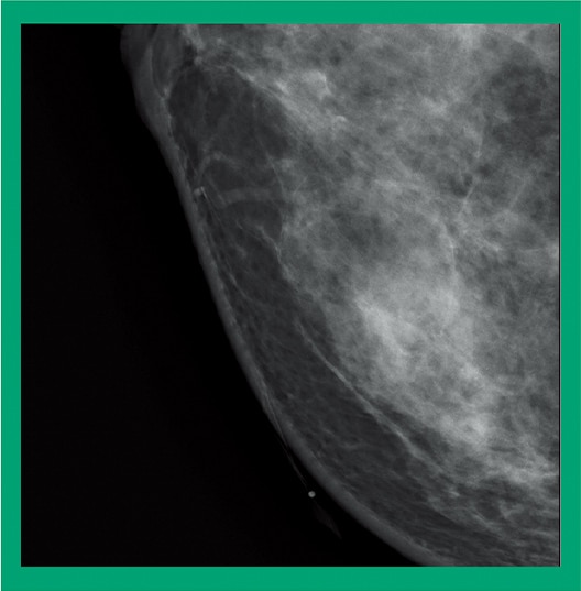 Mammografia digitale Amulet Sophinity di FUJIFILM per diagnostica senologica avanzata
