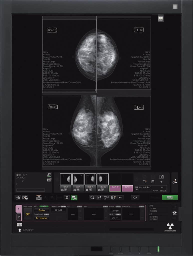 Mammografia digitale Amulet Sophinity di FUJIFILM per diagnostica senologica avanzata