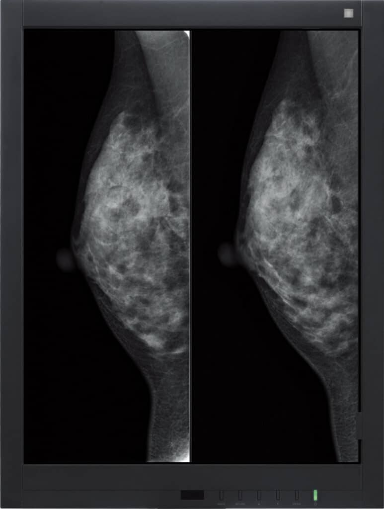 Mammografia digitale Amulet Sophinity di FUJIFILM per diagnostica senologica avanzata